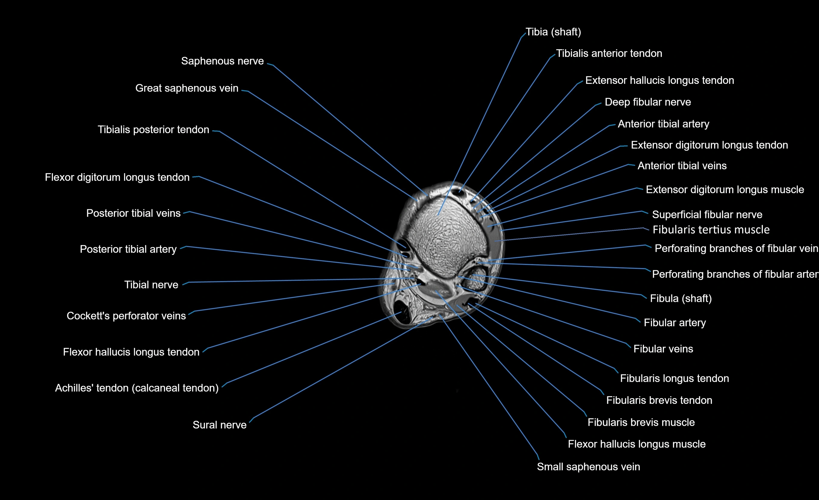 MRI lower leg axial cross sectional anatomy 3T  radiology  image-img-00001-00096.webp